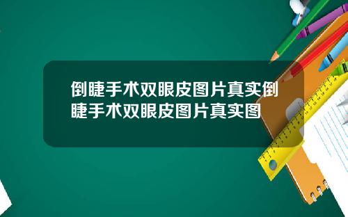 倒睫手术双眼皮图片真实倒睫手术双眼皮图片真实图