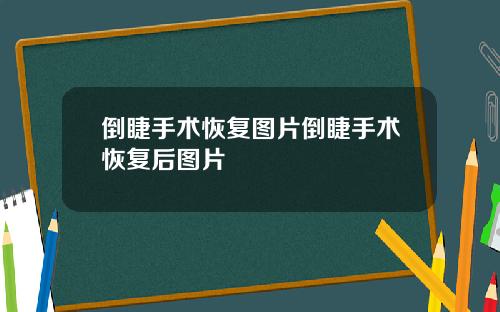 倒睫手术恢复图片倒睫手术恢复后图片