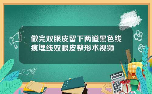 做完双眼皮留下两道黑色线痕埋线双眼皮整形术视频