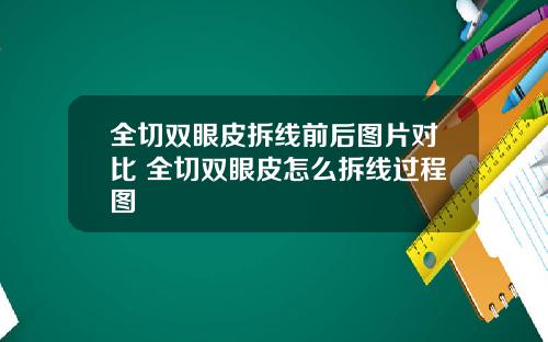 全切双眼皮拆线前后图片对比 全切双眼皮怎么拆线过程图