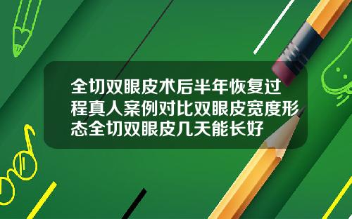 全切双眼皮术后半年恢复过程真人案例对比双眼皮宽度形态全切双眼皮几天能长好