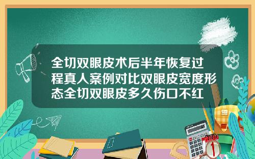 全切双眼皮术后半年恢复过程真人案例对比双眼皮宽度形态全切双眼皮多久伤口不红
