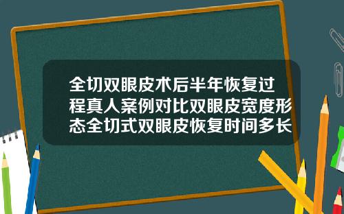 全切双眼皮术后半年恢复过程真人案例对比双眼皮宽度形态全切式双眼皮恢复时间多长