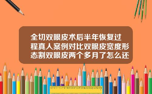 全切双眼皮术后半年恢复过程真人案例对比双眼皮宽度形态割双眼皮两个多月了怎么还不自然呢