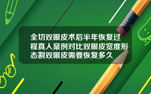 全切双眼皮术后半年恢复过程真人案例对比双眼皮宽度形态割双眼皮需要恢复多久