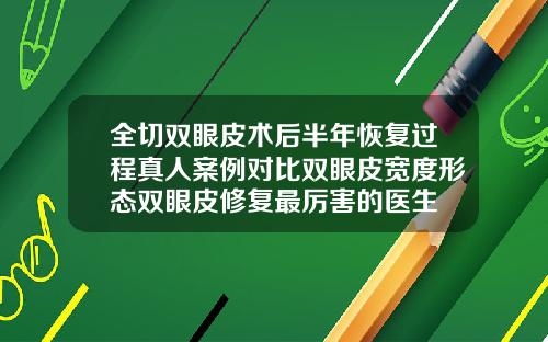 全切双眼皮术后半年恢复过程真人案例对比双眼皮宽度形态双眼皮修复最厉害的医生