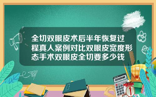 全切双眼皮术后半年恢复过程真人案例对比双眼皮宽度形态手术双眼皮全切要多少钱