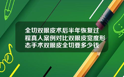 全切双眼皮术后半年恢复过程真人案例对比双眼皮宽度形态手术双眼皮全切要多少钱