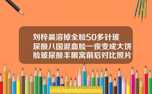 刘梓晨溶掉全脸50多针玻尿酸八国混血脸一夜变成大饼脸玻尿酸丰眼窝前后对比照片