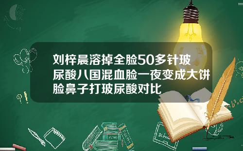 刘梓晨溶掉全脸50多针玻尿酸八国混血脸一夜变成大饼脸鼻子打玻尿酸对比