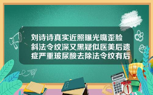刘诗诗真实近照曝光嘴歪脸斜法令纹深又黑疑似医美后遗症严重玻尿酸去除法令纹有后遗症吗