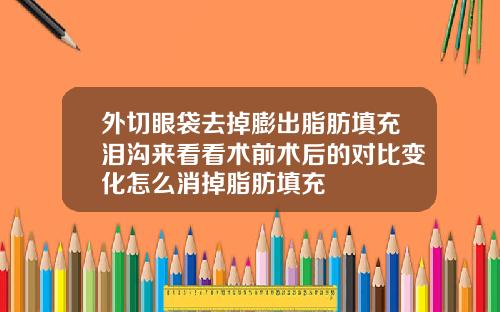 外切眼袋去掉膨出脂肪填充泪沟来看看术前术后的对比变化怎么消掉脂肪填充