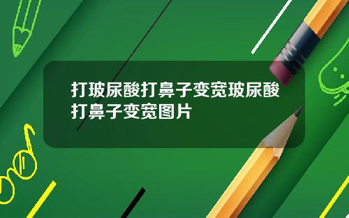 打玻尿酸打鼻子变宽玻尿酸打鼻子变宽图片