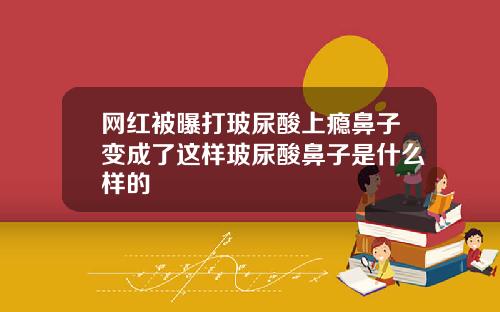 网红被曝打玻尿酸上瘾鼻子变成了这样玻尿酸鼻子是什么样的