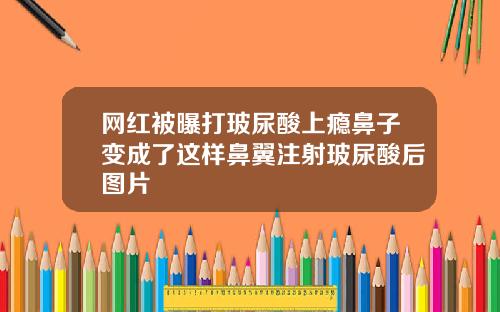 网红被曝打玻尿酸上瘾鼻子变成了这样鼻翼注射玻尿酸后图片