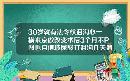 30岁就有法令纹泪沟心一横来京做改变术后3个月不P图也自信玻尿酸打泪沟几天消肿